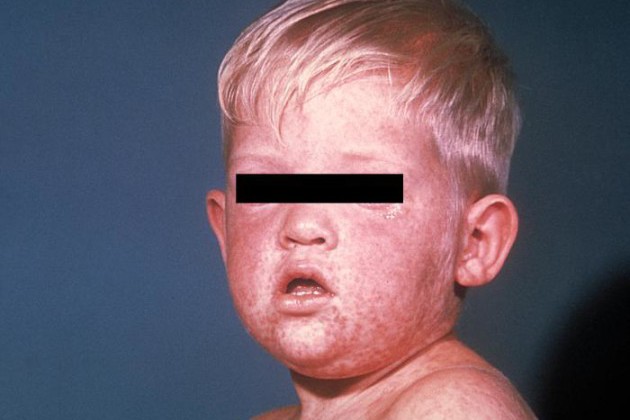 California Department of Public Health Declares Disneyland Measles Outbreak Over